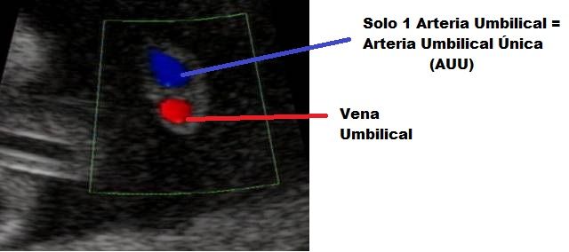 arteria umbilical unica