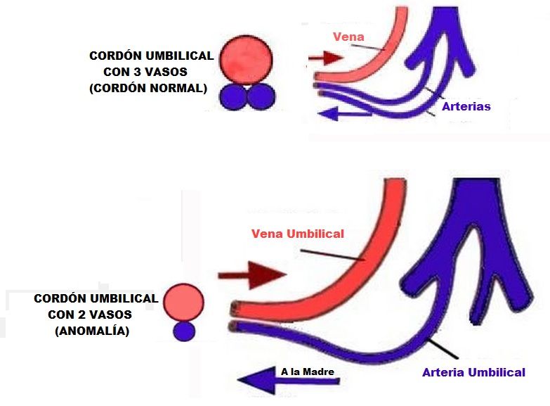 cordon umbilical con 2 vasos