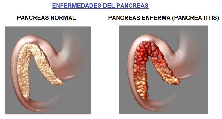 enfermedades del pancreas