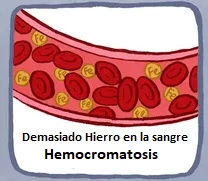 Hemocromatosis